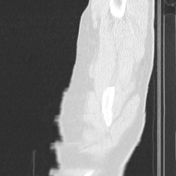 File:Acute aspiration pneumonitis (Radiopaedia 33605-34703 Sagittal lung window 3).jpg