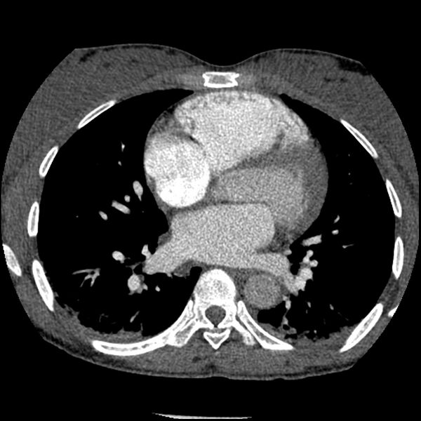File:Acute chest syndrome - sickle cell disease (Radiopaedia 42375-45499 Axial C+ CTPA 106).jpg