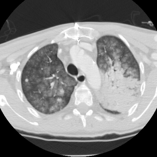 File:Acute diffuse alveolar hemorrhage (Radiopaedia 41323-44158 Axial lung window 13).jpg