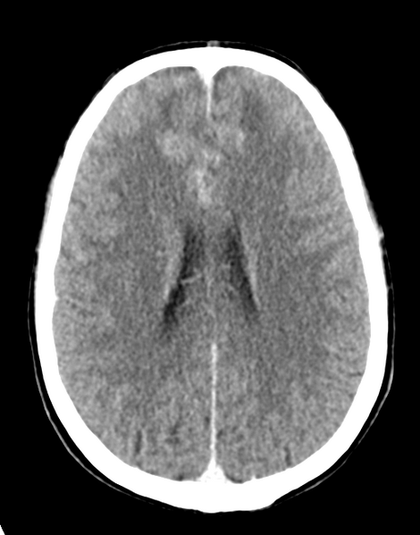 File:Acute disseminated encephalomyelitis (ADEM) (Radiopaedia 65319-74348 Axial C+ delayed 20).png
