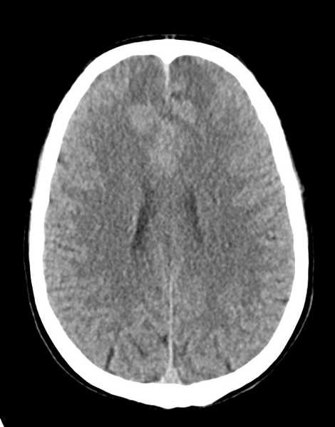 File:Acute disseminated encephalomyelitis (ADEM) (Radiopaedia 65319-74348 Axial non-contrast 21).png