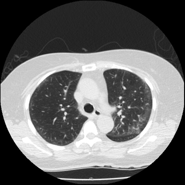 File:Acute interstitial pneumonitis (Radiopaedia 45404-49444 Axial lung window 37).jpg