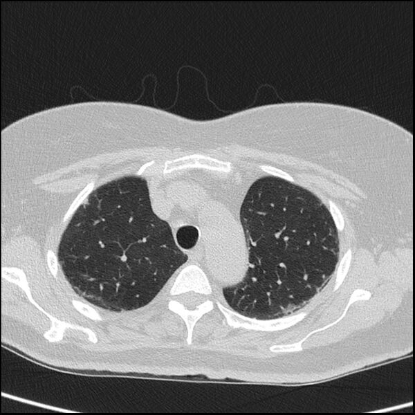 File:Acute interstitial pneumonitis (Radiopaedia 45404-49453 Axial lung window 21).jpg