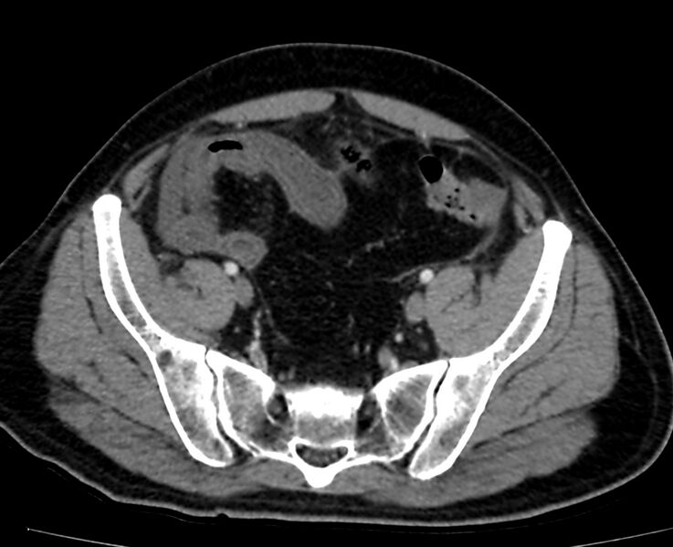 File:Acute mesenteric ischemia - superior mesenteric artery thrombosis (Radiopaedia 73947-84776 Axial C+ arterial phase 133).jpg