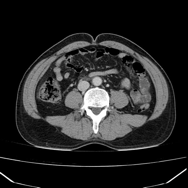 File:Acute pancreatitis (Radiopaedia 22572-22596 Axial C+ portal venous phase 43).jpg