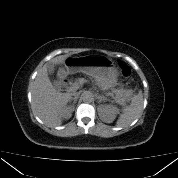 File:Acute pancreatitis - Balthazar C (Radiopaedia 26569-26714 Axial non-contrast 30).jpg