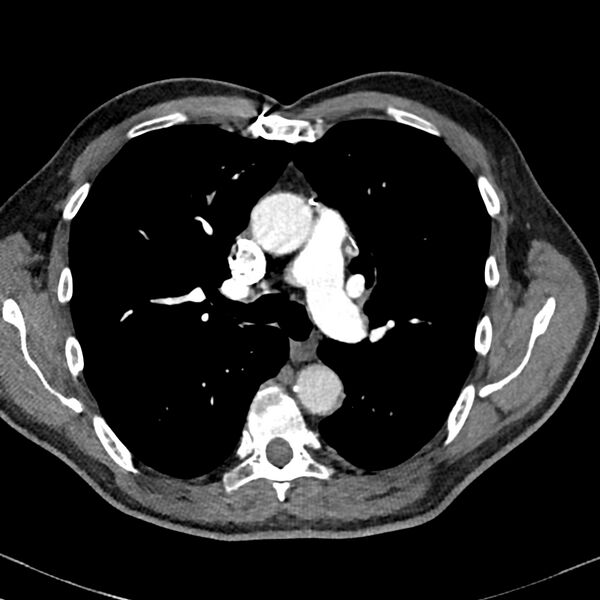 File:Acute pulmonary embolism (Radiopaedia 81677-95570 Axial C+ CTPA 34).jpg