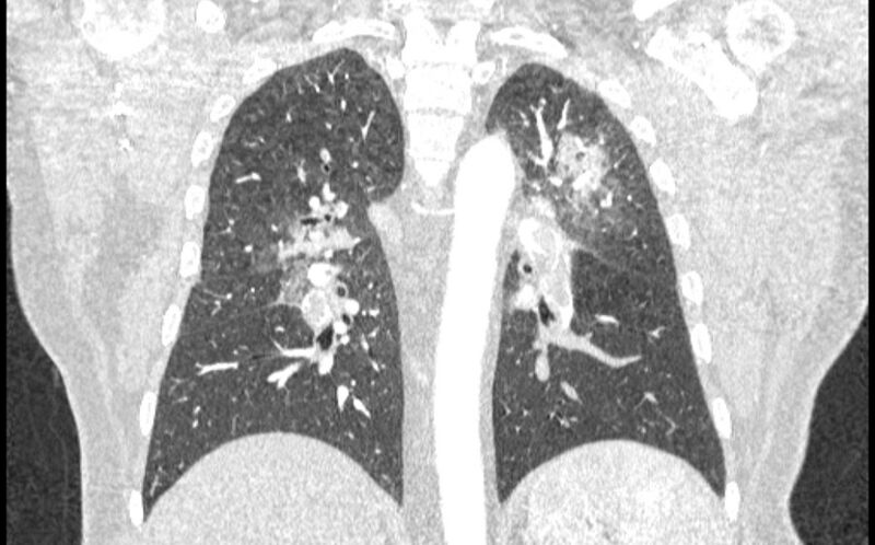 File:Acute pulmonary embolism with pulmonary infarcts (Radiopaedia 77688-89908 Coronal lung window 64).jpg