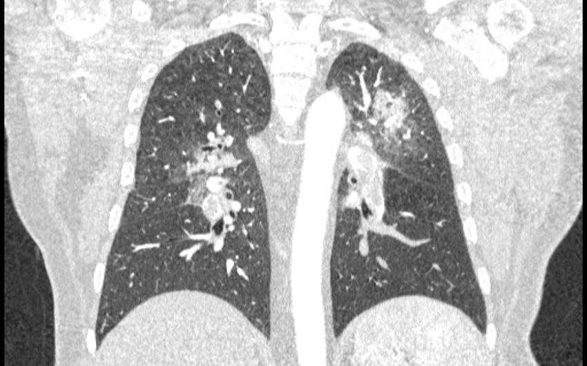 Acute pulmonary embolism with pulmonary infarcts (Radiopaedia 77688-89908 Coronal lung window 64).jpg