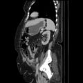 Acute pyelonephritis (Radiopaedia 25657-25837 Sagittal renal parenchymal phase 57).jpg