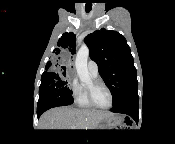 File:Acute right lung abscess (Radiopaedia 34806-36258 Coronal C+ arterial phase 39).jpg