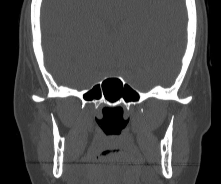 File:Acute sinusitis (Radiopaedia 22419-22455 Coronal bone window 33).jpg