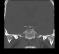 Acute sinusitis (Radiopaedia 23161-23215 Coronal bone window 58).jpg