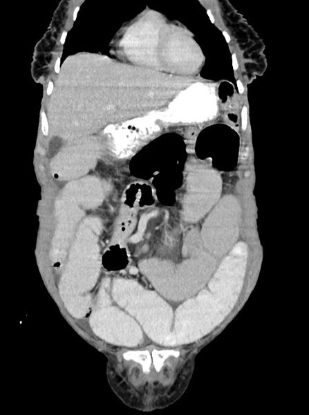 File:Acute small bowel (ileal) volvulus (Radiopaedia 71740-82139 Coronal C+ portal venous phase 31).jpg