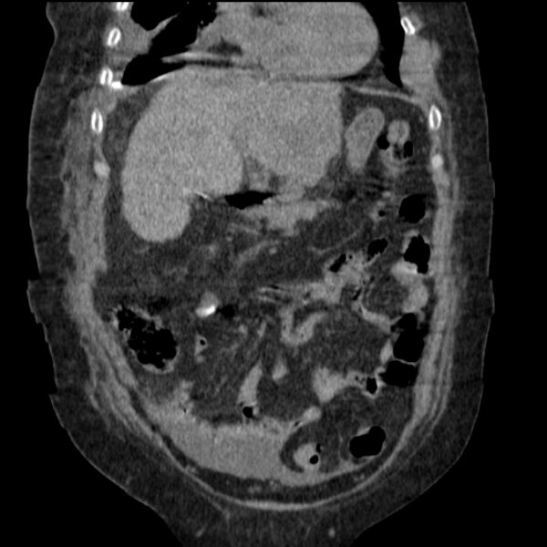 File:Acute tubular necrosis (Radiopaedia 28077-28334 D 30).jpg