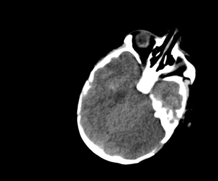 File:Acute ventriculitis (Radiopaedia 57502-64459 Axial non-contrast 6).jpg