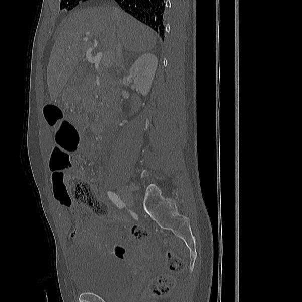 File:Acute vertebral body compression fractures (Radiopaedia 31757-32693 Sagittal bone window 44).jpg
