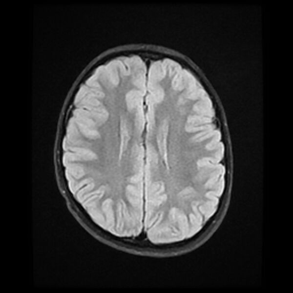 File:Adamantinomatous craniopharyngioma (Radiopaedia 77407-89529 Axial FLAIR 17).jpg