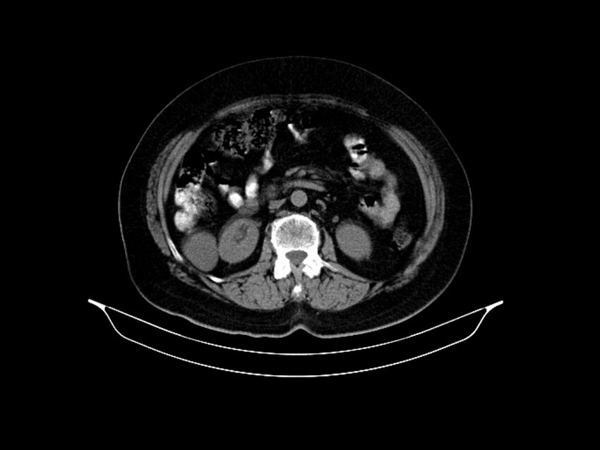 Adenocarcinoma of pancreas with hepatic metastasis (Radiopaedia 64332-73122 Axial non-contrast 48).jpg