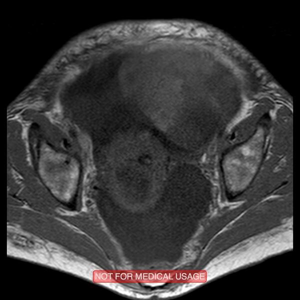 File:Adenocarcinoma of the cervix (Radiopaedia 28373-28615 Axial T1 13).jpg