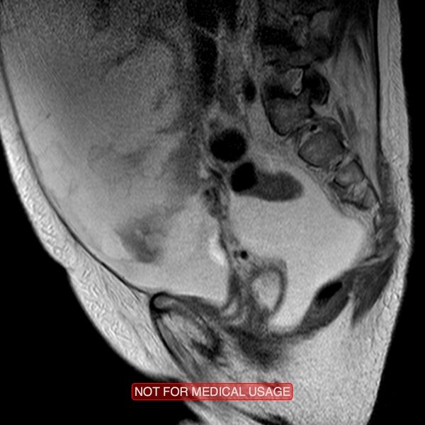 File:Adenocarcinoma of the cervix (Radiopaedia 28373-28615 Sagittal T2 4).jpg