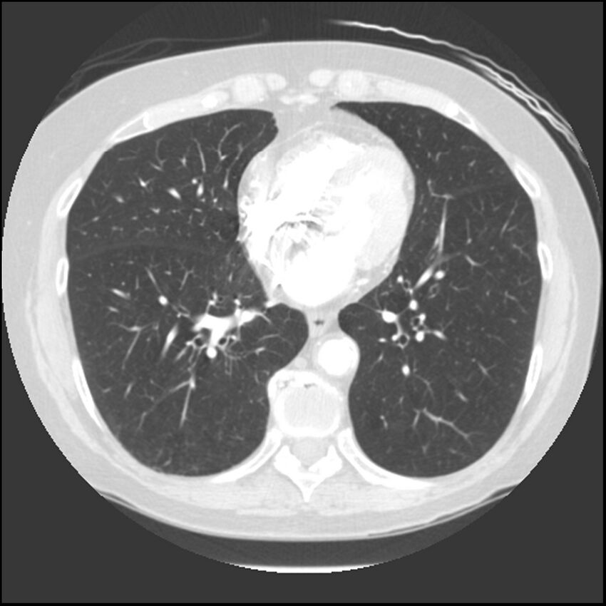 Adenocarcinoma of the lung (Radiopaedia 41015-43755 Axial lung window 79).jpg