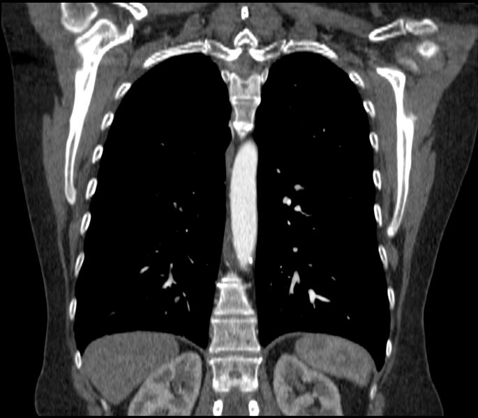 File:Adenocarcinoma of the lung (Radiopaedia 44205-47803 Coronal C+ portal venous phase 67).jpg