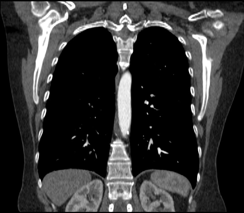 Adenocarcinoma of the lung (Radiopaedia 44205-47803 Coronal C+ portal venous phase 67).jpg