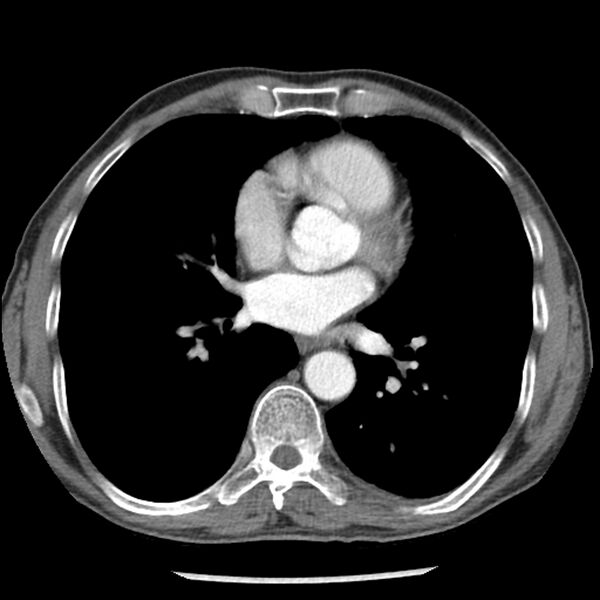 File:Adenocarcinoma of the lung - micropapillary predominant (Radiopaedia 42446-45563 Axial C+ portal venous phase 43).jpg