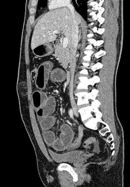 File:Adhesional small bowel obstruction (Radiopaedia 58900-66131 Sagittal C+ portal venous phase 109).jpg