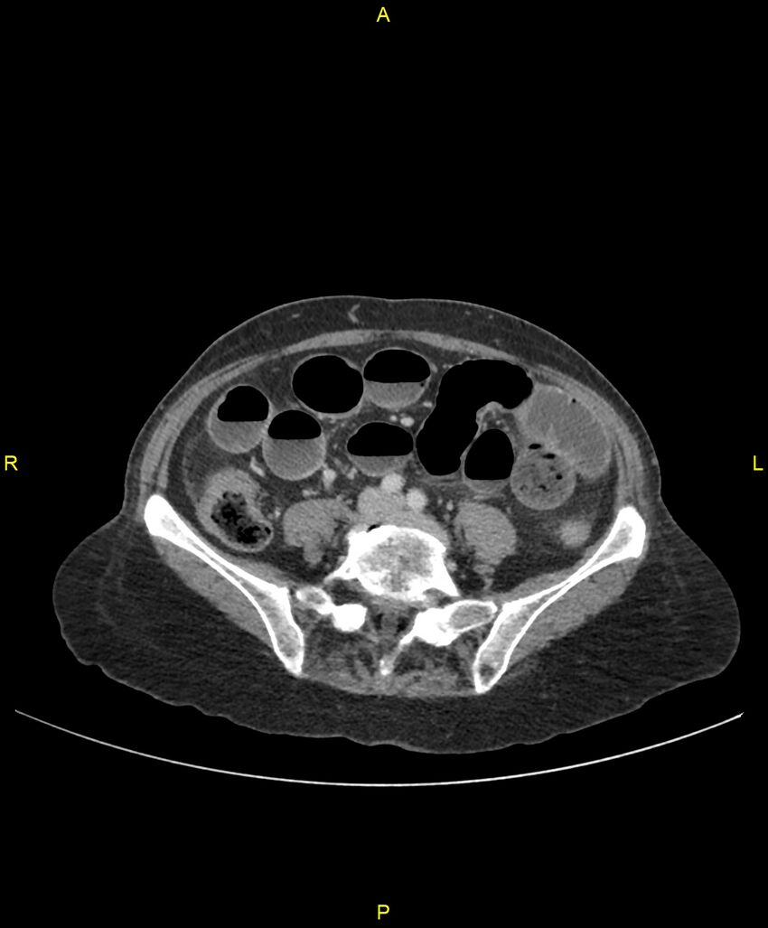 Adhesional small bowel obstruction (Radiopaedia 85402-101024 Axial C+ portal venous phase 184).jpg
