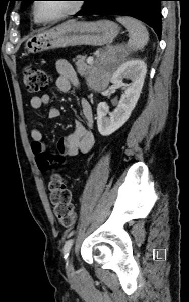 File:Adrenal lymphoma (Radiopaedia 73730-84529 Sagittal C+ portal venous phase 79).jpg