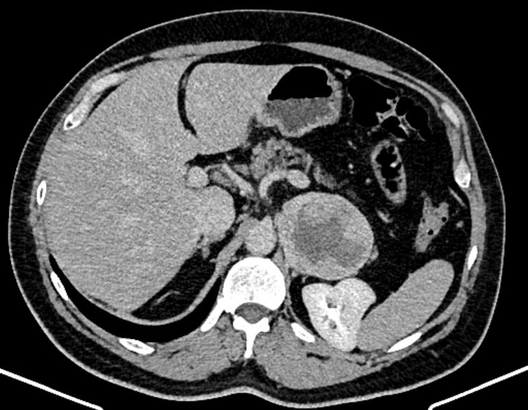 File:Adrenal metastases (Radiopaedia 73082-83791 Axial C+ delayed 88).jpg
