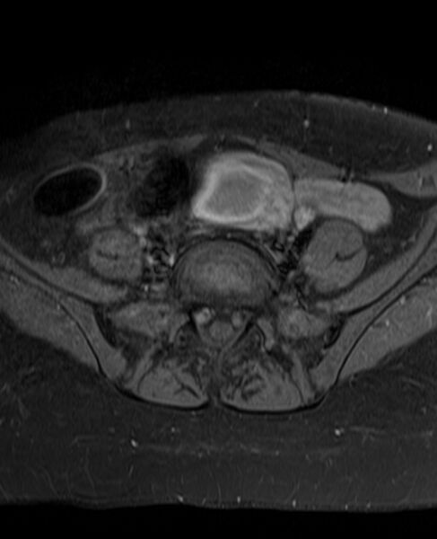File:Adult granulosa cell tumor of the ovary (Radiopaedia 71581-81950 Axial T1 C+ fat sat 6).jpg