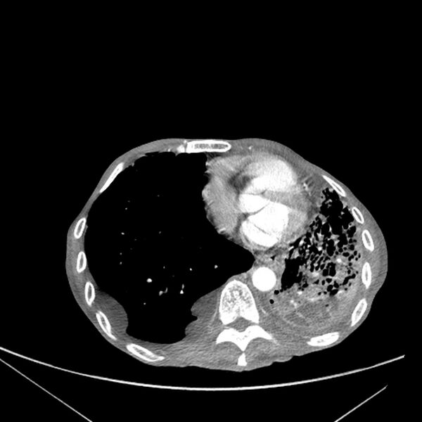 File:Advanced pulmonary tuberculosis (Radiopaedia 8599-9431 Axial liver window 13).jpg