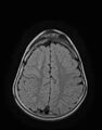 Aicardi syndrome (Radiopaedia 66029-75205 Axial FLAIR 20).jpg
