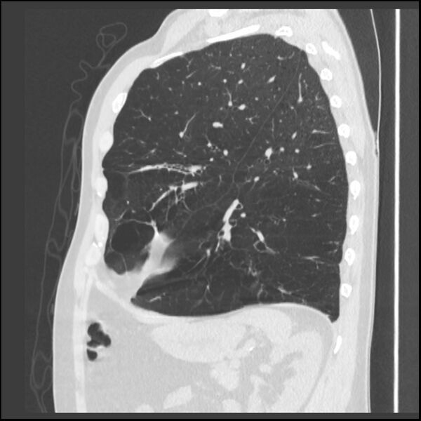 File:Alpha-1-antitrypsin deficiency (Radiopaedia 40993-43722 Sagittal lung window 79).jpg