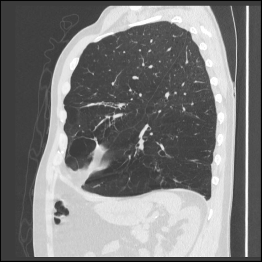 Alpha-1-antitrypsin deficiency (Radiopaedia 40993-43722 Sagittal lung window 79).jpg