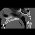 Ameloblastic fibro-odontoma (Radiopaedia 18843-18780 bone window 1).jpg