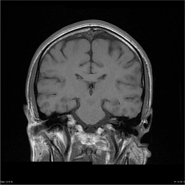 File:Amnestic syndrome secondary to hypoxic brain injury (Radiopaedia 24743-25004 B 12).jpg