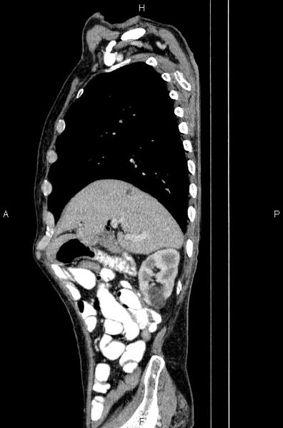 File:Ampullary adenocarcinoma (Radiopaedia 86093-102033 E 23).jpg