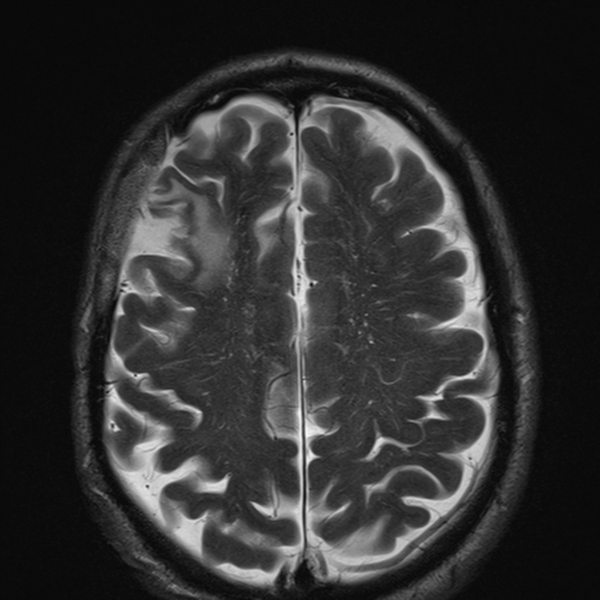 File:Anaplastic meningioma with recurrence (Radiopaedia 34452-35788 Axial T2 21).png