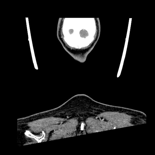 File:Anaplastic thyroid carcinoma (Radiopaedia 79087-92034 A 114).jpg