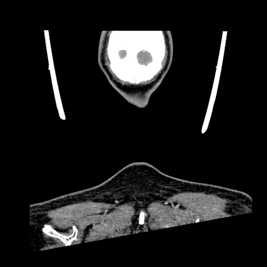 Anaplastic thyroid carcinoma (Radiopaedia 79087-92034 A 114).jpg