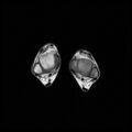 Aneurysmal bone cyst - tibia (Radiopaedia 22343-22367 Axial T1 17).jpg
