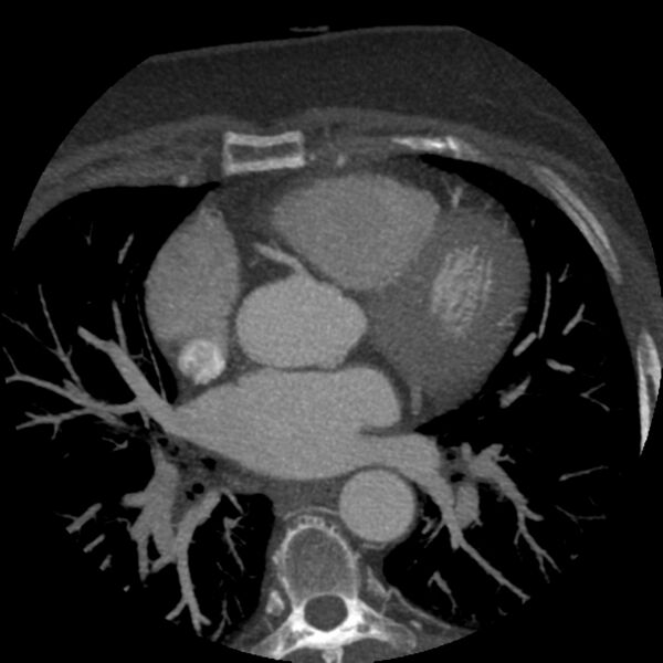 File:Anomalous origin of left circumflex artery from right coronary sinus (Radiopaedia 72563-83117 A 39).jpg