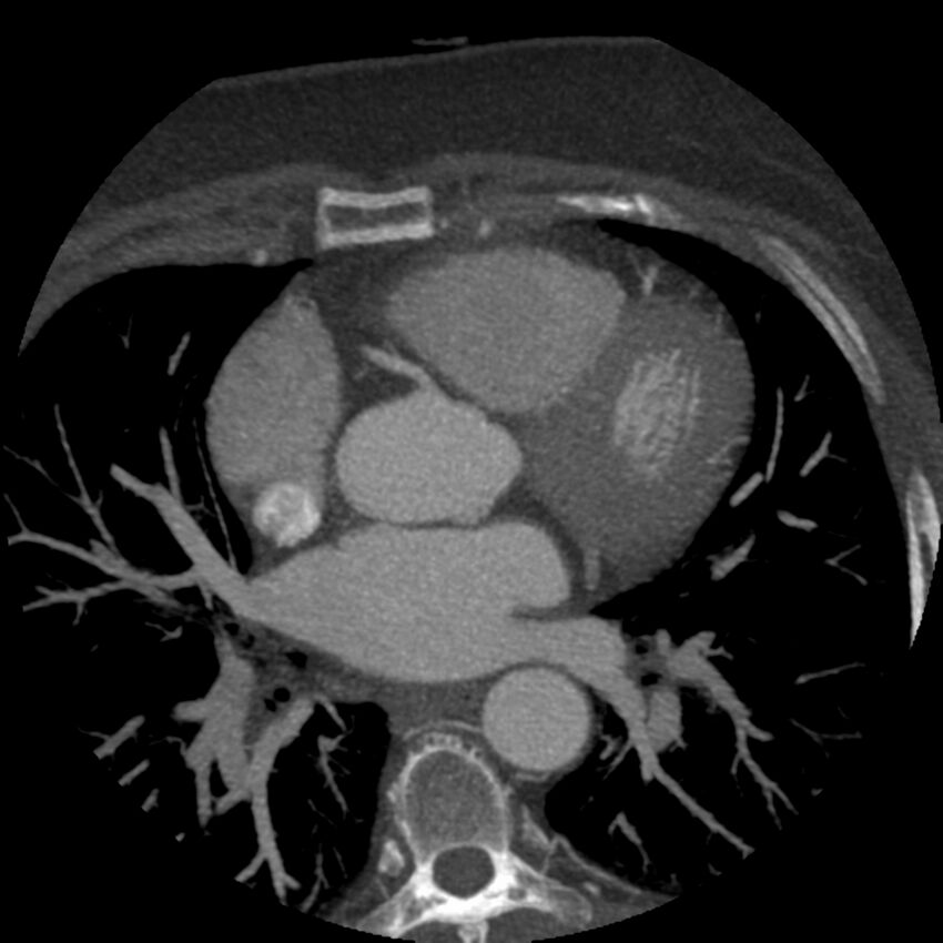 Anomalous origin of left circumflex artery from right coronary sinus (Radiopaedia 72563-83117 A 39).jpg