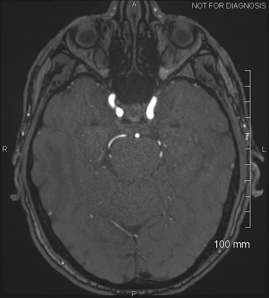 File:Anterior cerebral artery aneurysm (Radiopaedia 80683-94127 Axial MRA 80).jpg