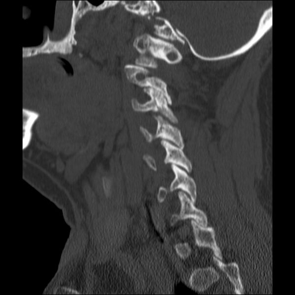 File:Anterior cervical postdiscectomy arthrodesis (Radiopaedia 32678-33646 Sagittal bone window 57).jpg