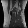 Anterior cruciate ligament tear, Wrisberg rip and bucket-handle tear of medial meniscus (Radiopaedia 75872-87266 Coronal T1 24).jpg